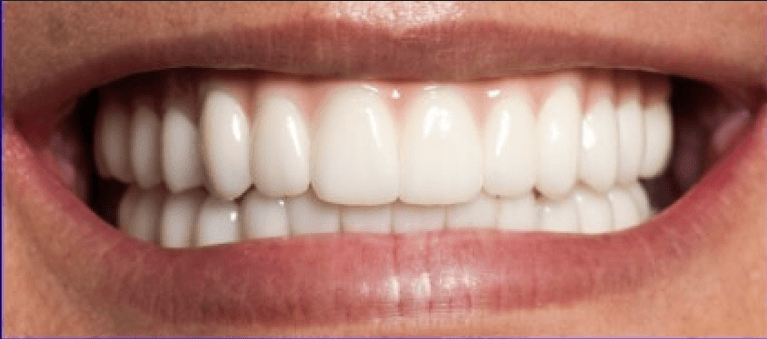 U-L-All-On-4-Fixed-Prosthesis-After-Image