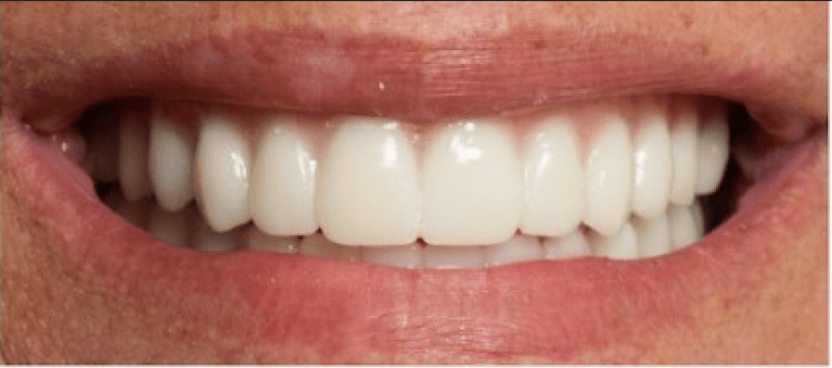 Upper-Denture-Lower-All-On-4-Fixed-Prosthesis-After-Image