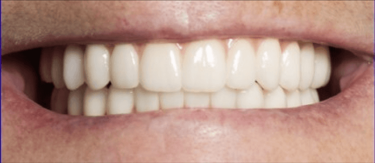 U-L-All-on-4-Fixed-Prosthesis-After-Image