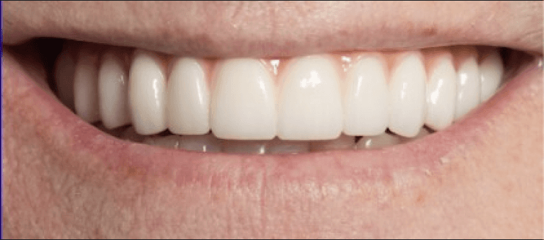 Upper-Lower-All-On-4-Fixed-Prosthesis-After-Image