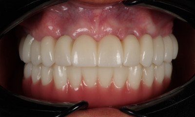 After treatment - Dental Implants and Crowns 
