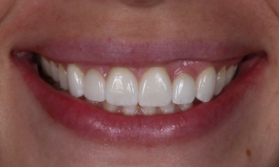 After treatment - Esthetic Crowns