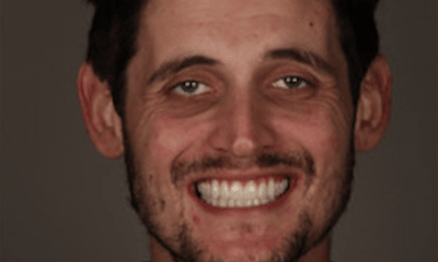 After treatment - Upper and Lower Dental Implants 