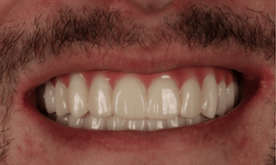 After treatment - Upper and Lower Dental Implants 