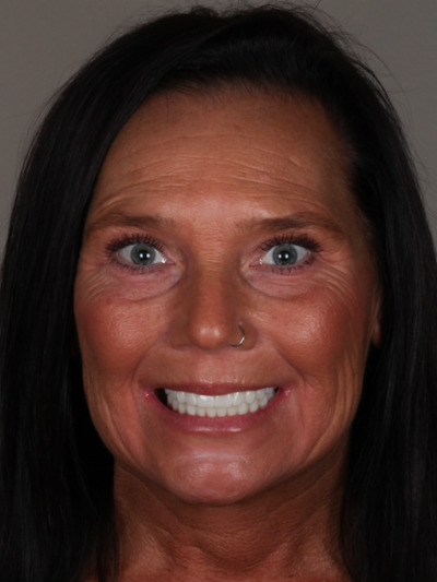 After treatment - Dental Implants and Crowns 