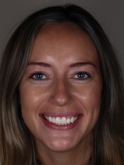 After treatment - Esthetic Crowns