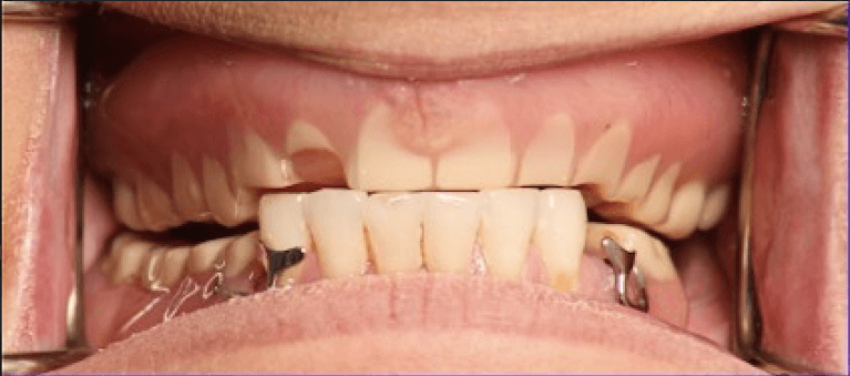 U-L-All-On-4-Fixed-Prosthesis-Before-Image