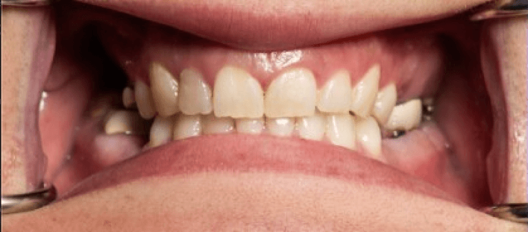 Upper-All-On-4-Fixed-Prosthesis-Before-Image