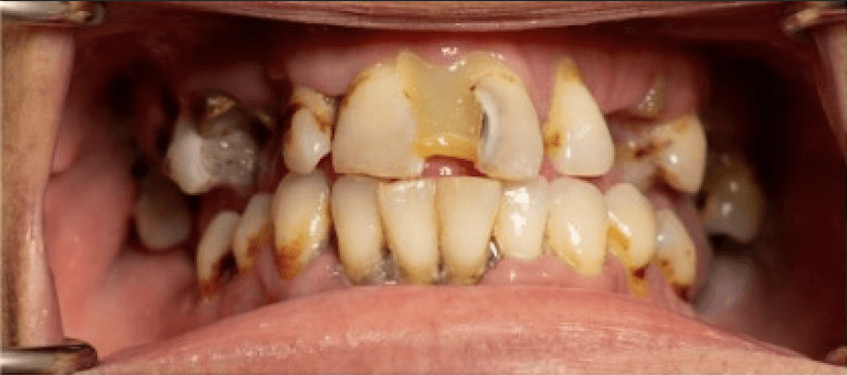 Upper-Denture-Lower-All-On-4-Fixed-Prosthesis-Before-Image