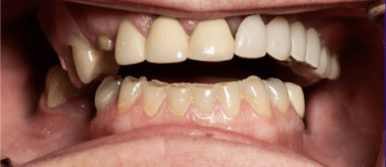 U-L-All-on-4-Fixed-Prosthesis-Before-Image