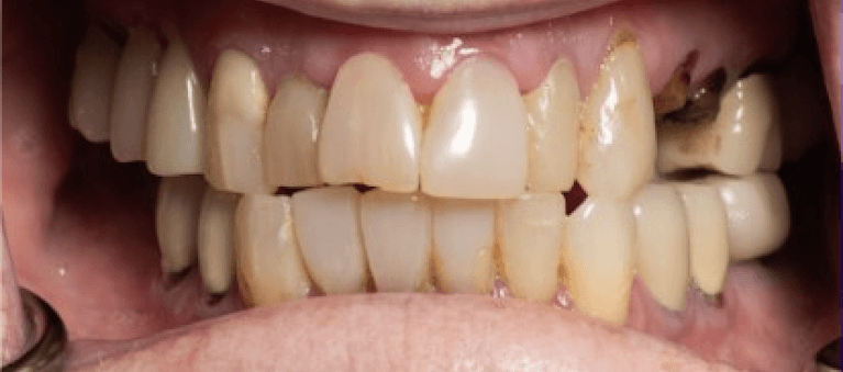 Upper-Lower-All-On-4-Fixed-Prosthesis-Before-Image