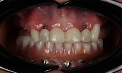 Before treatment - Dental Implants and Crowns 