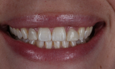 Before treatment - Esthetic Crowns