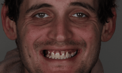 Before treatment - Upper and Lower Dental Implants 