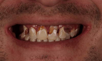 Before treatment - Upper and Lower Dental Implants 