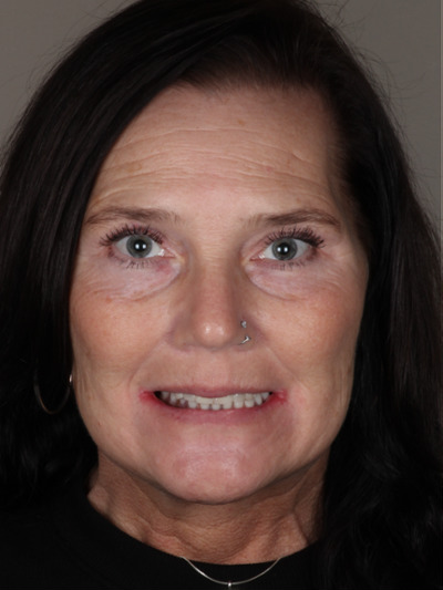 Before treatment - Dental Implants and Crowns 