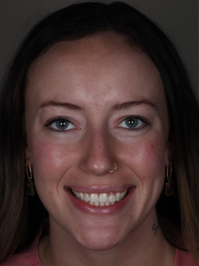 Before treatment - Esthetic Crowns