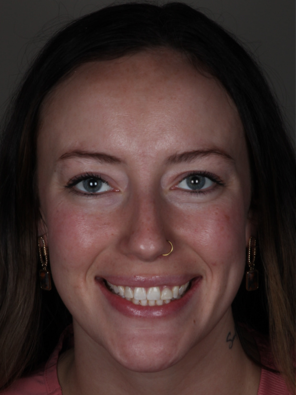 Tallassee Dental | Close-up of a person's mouth showing straight, white teeth after dental treatment.